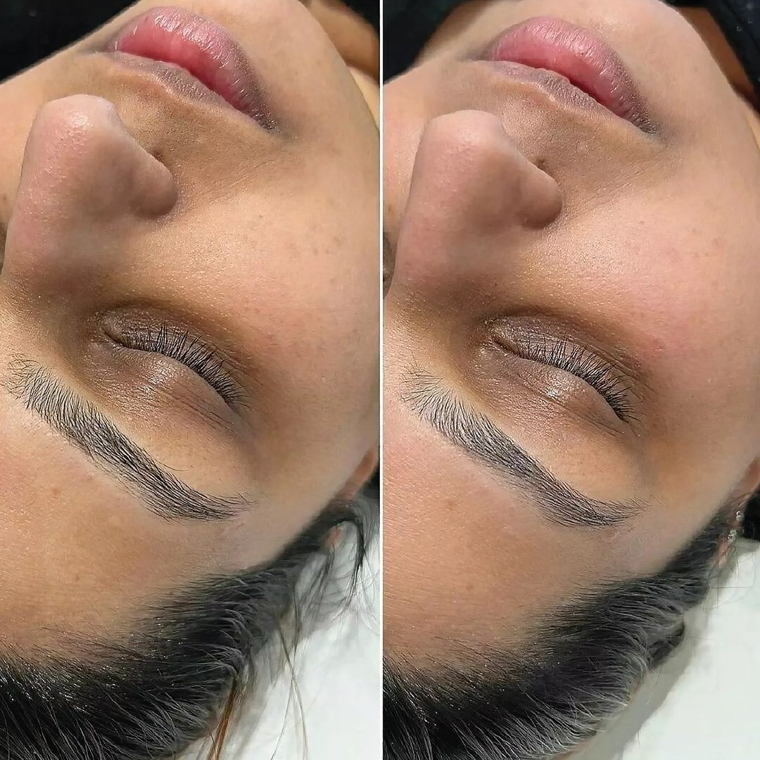 Exofacial skin smoothing result