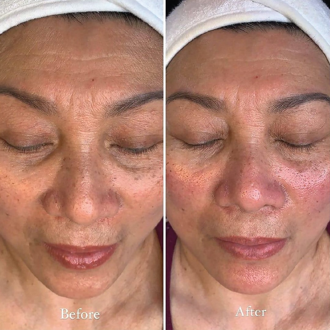 Exofacial glow result