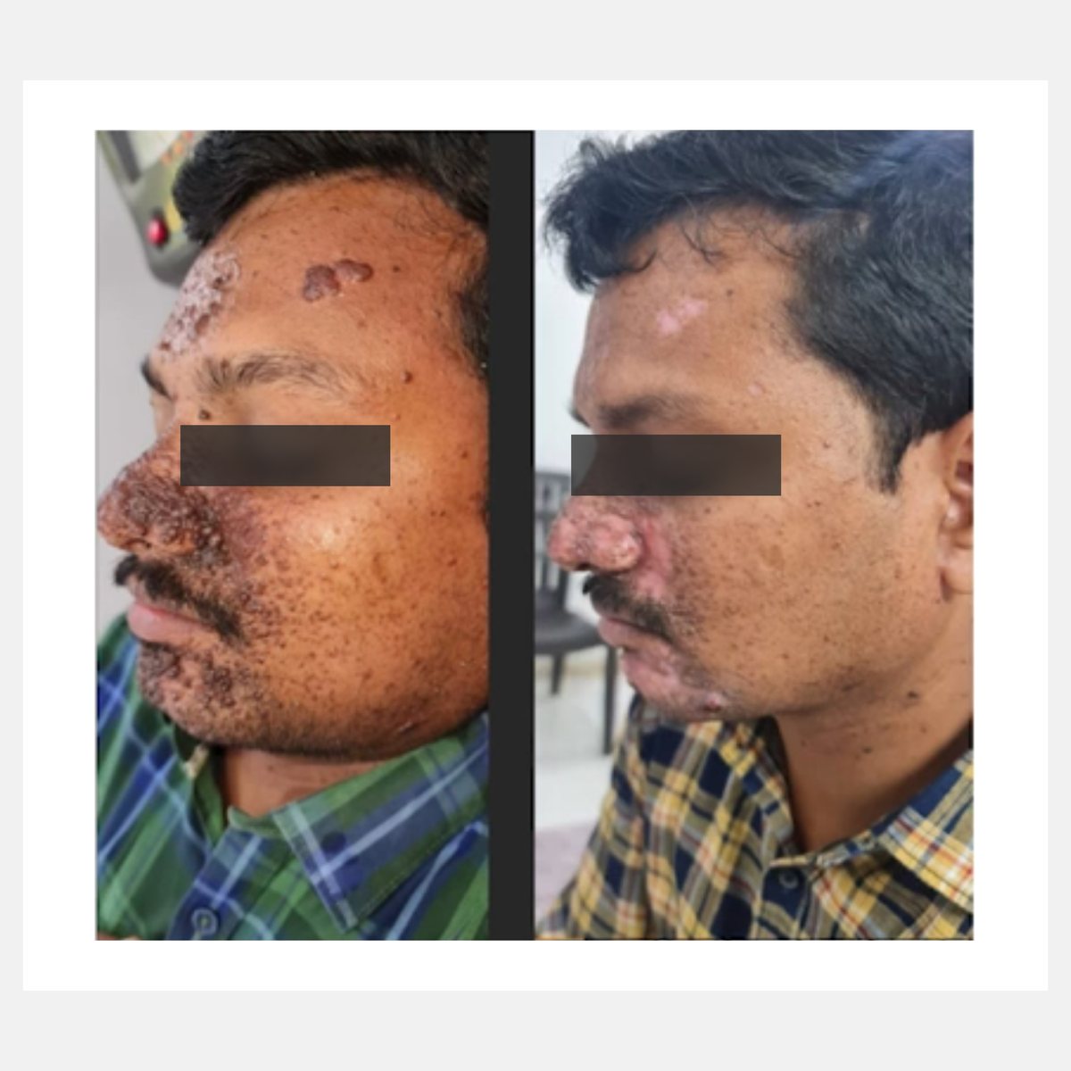 Magic Pulse CO₂ before and after result