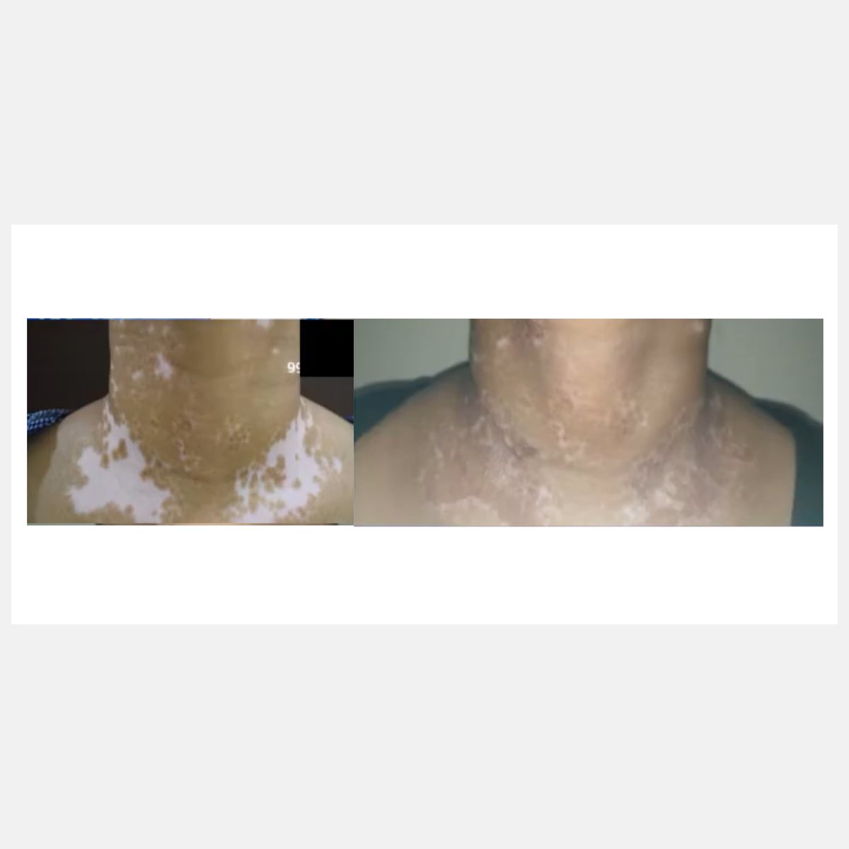 Magic Pulse CO₂ before and after result