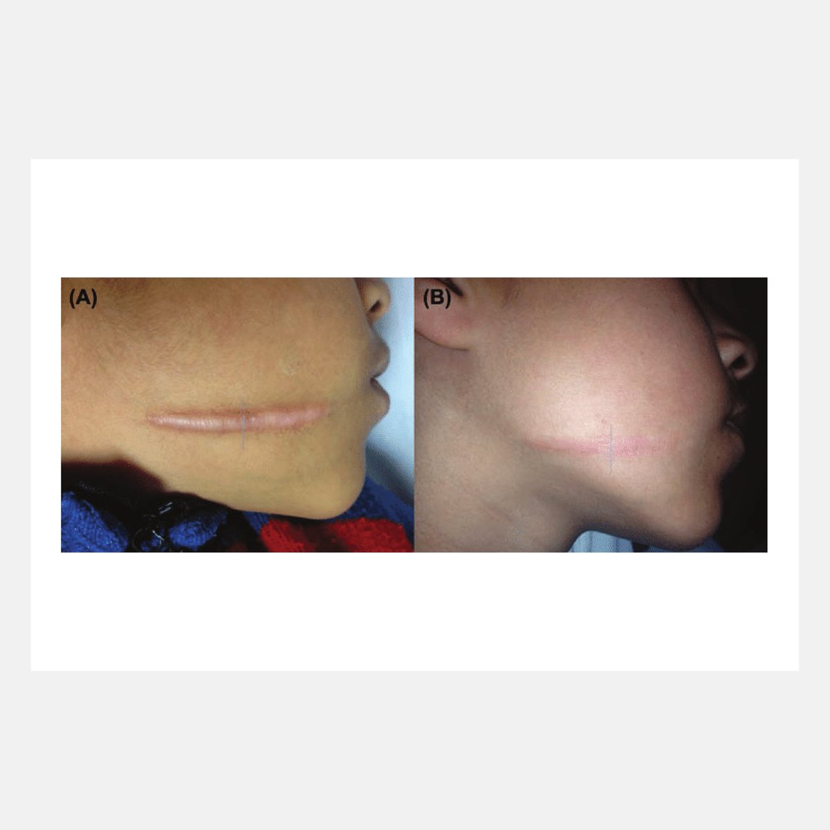 Magic Pulse CO₂ before and after result