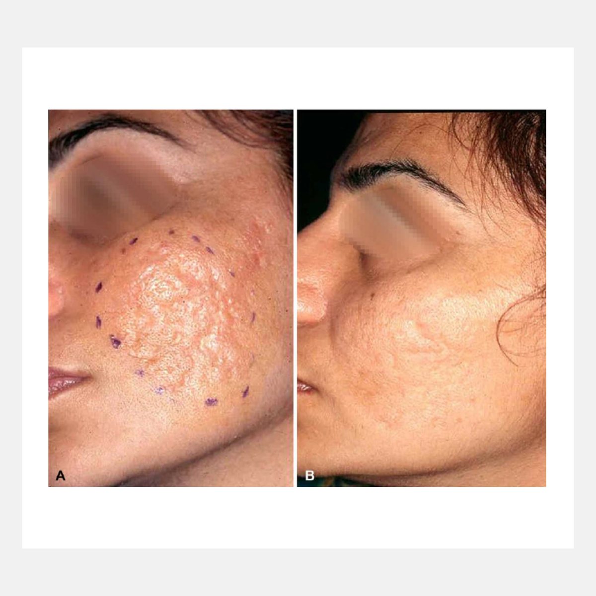 Magic Pulse CO₂ before and after result