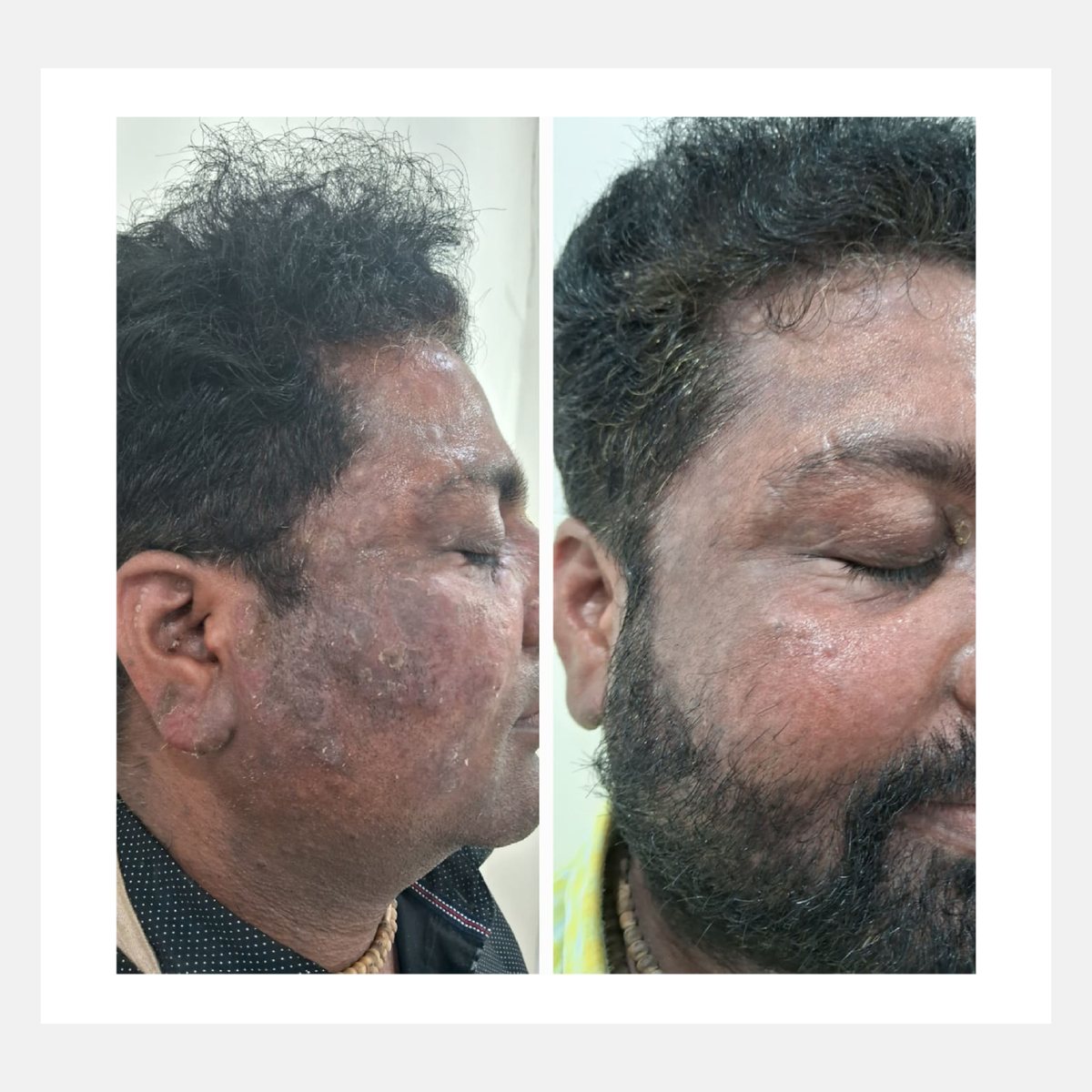 Magic Pulse CO₂ before and after result