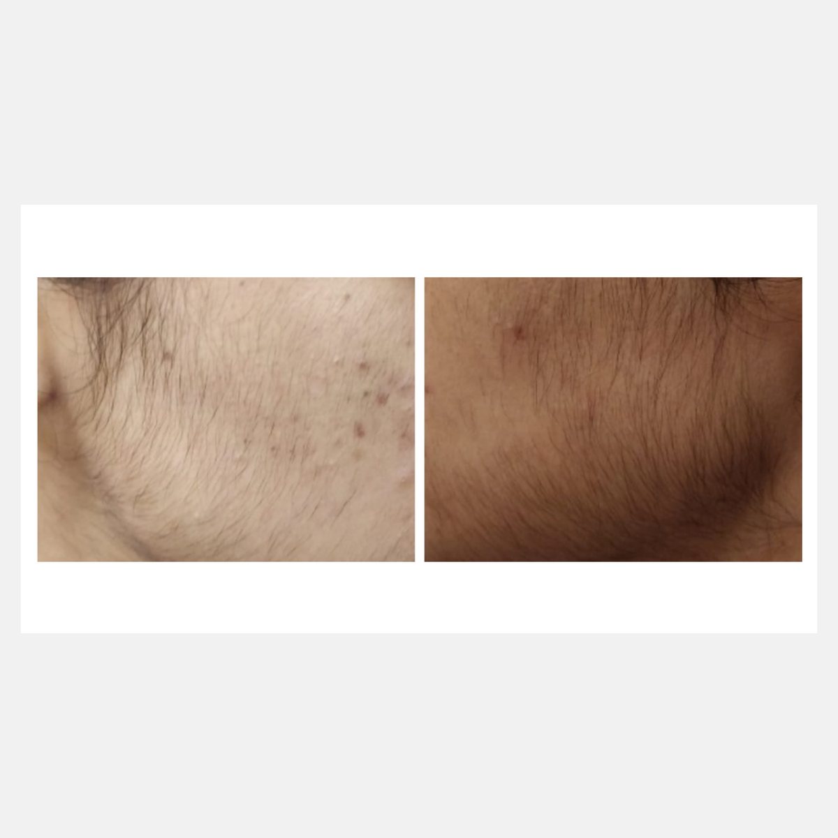 Vossman before and after result