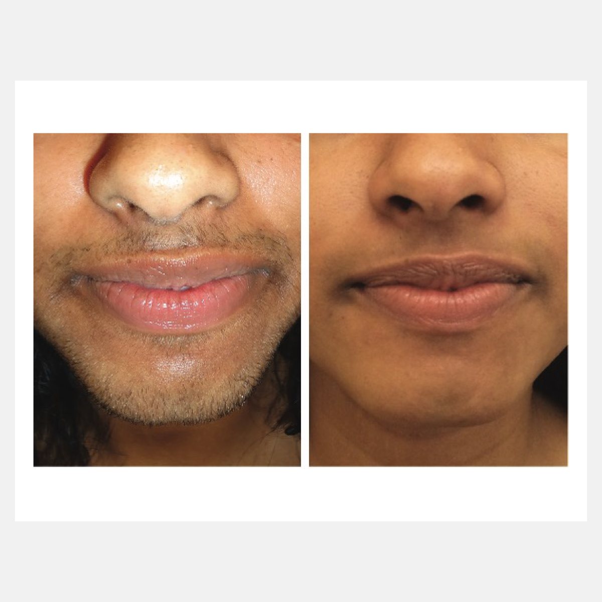 Vossman before and after result
