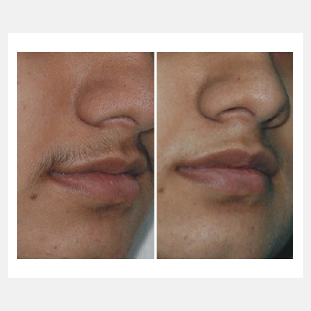 Vossman before and after result