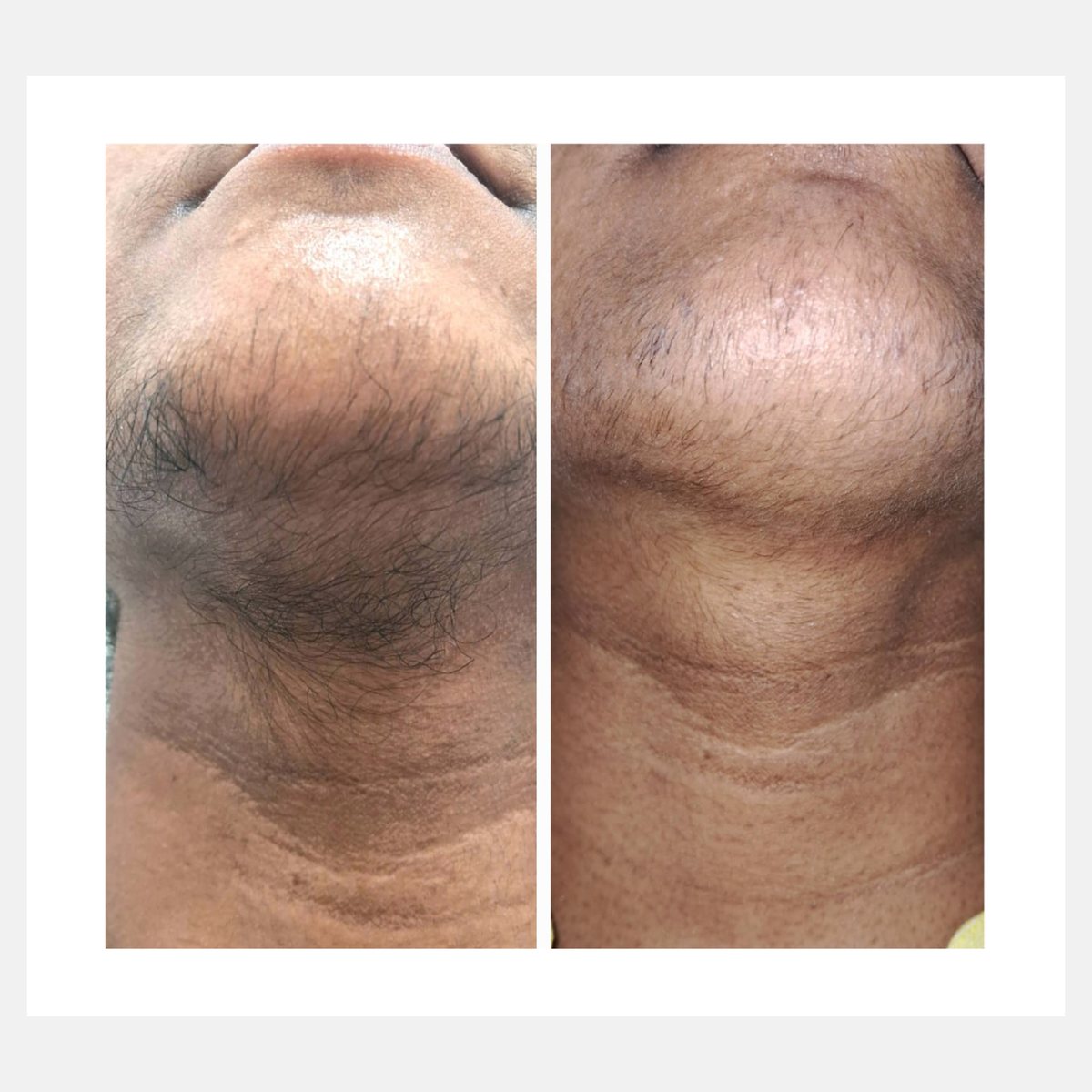 Vossman before and after result