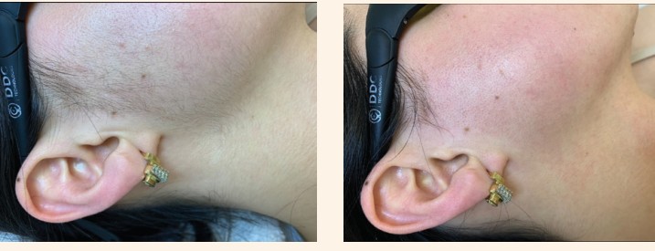 Polylase hair removal on the face, before and after