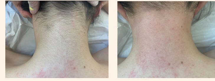 Polylase hair removal on the neck, before and after