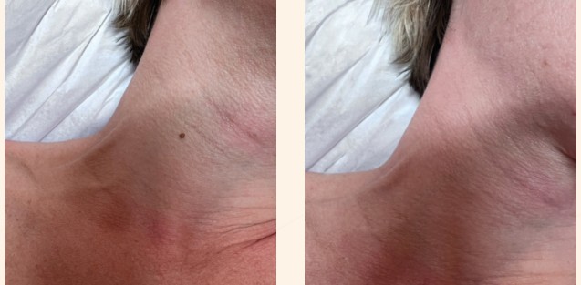 Polylase benign skin growths, before and after