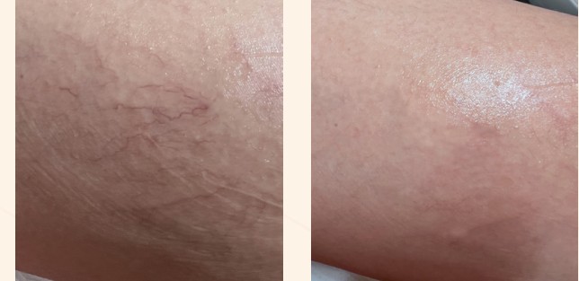 Polylase vascular vein clearance, before and after