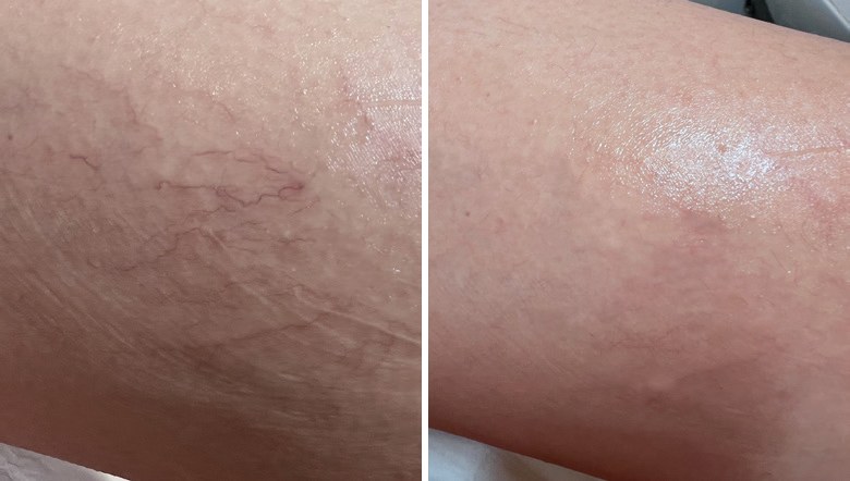 Polylase ND before and after — leg and spider veins