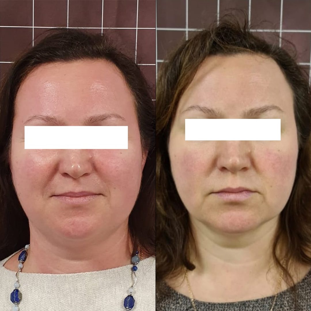 UTIMS A3 before and after result
