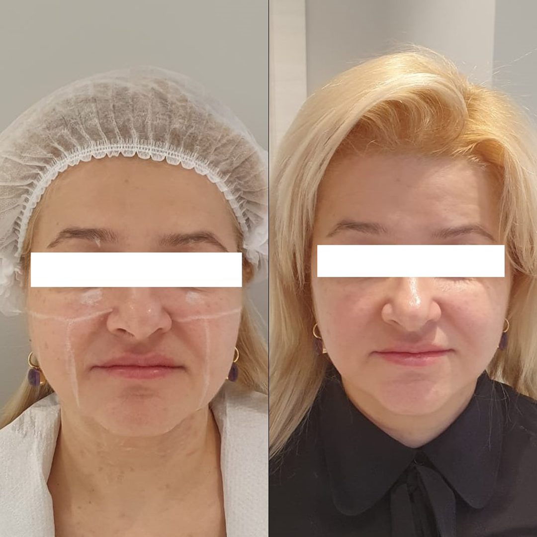 UTIMS A3 before and after result
