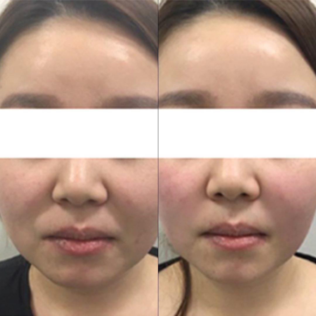UTIMS A3 before and after result