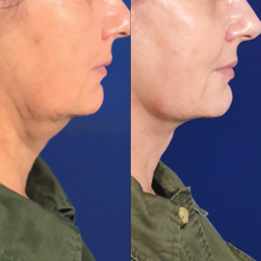 UTIMS A3 before and after result