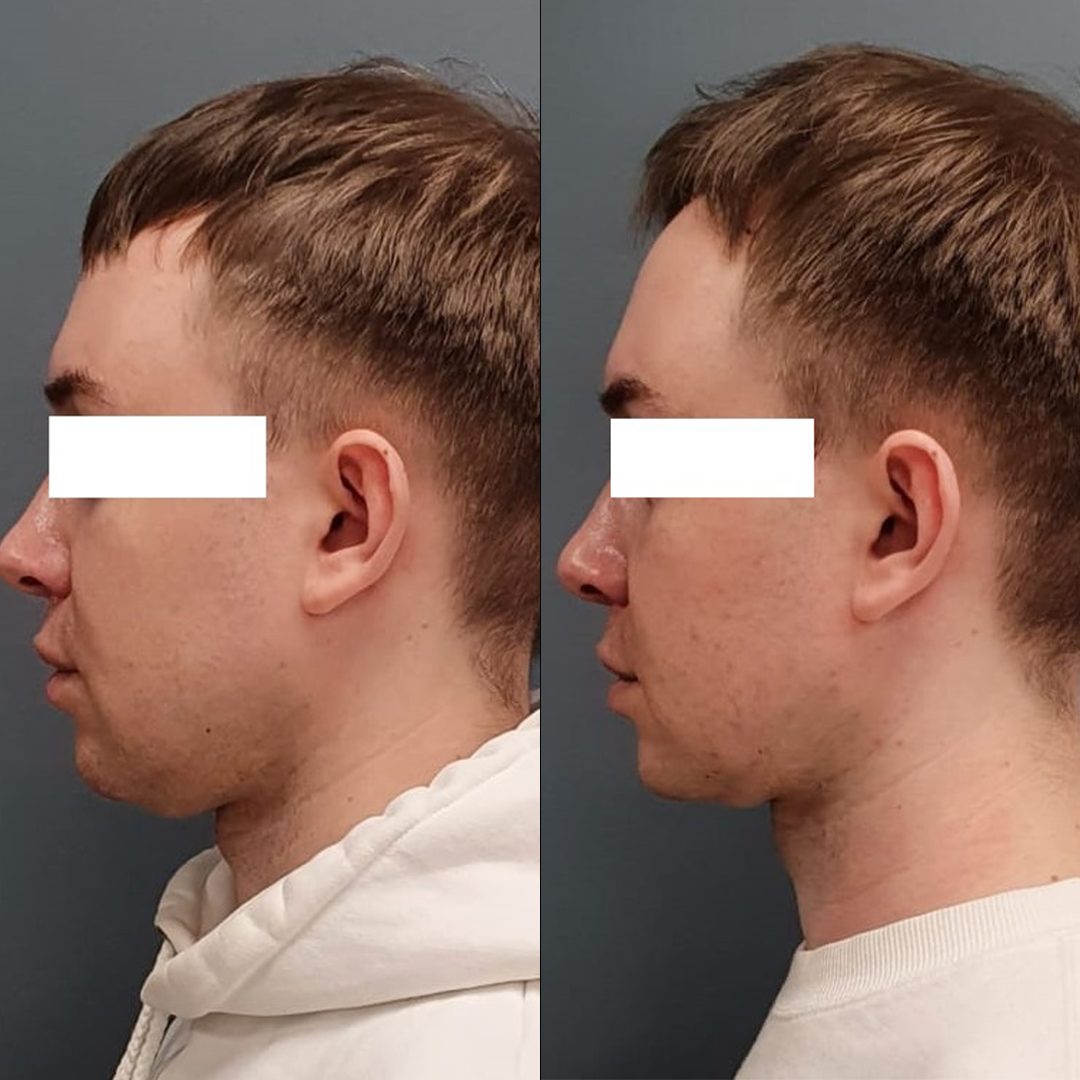 UTIMS A3 before and after result