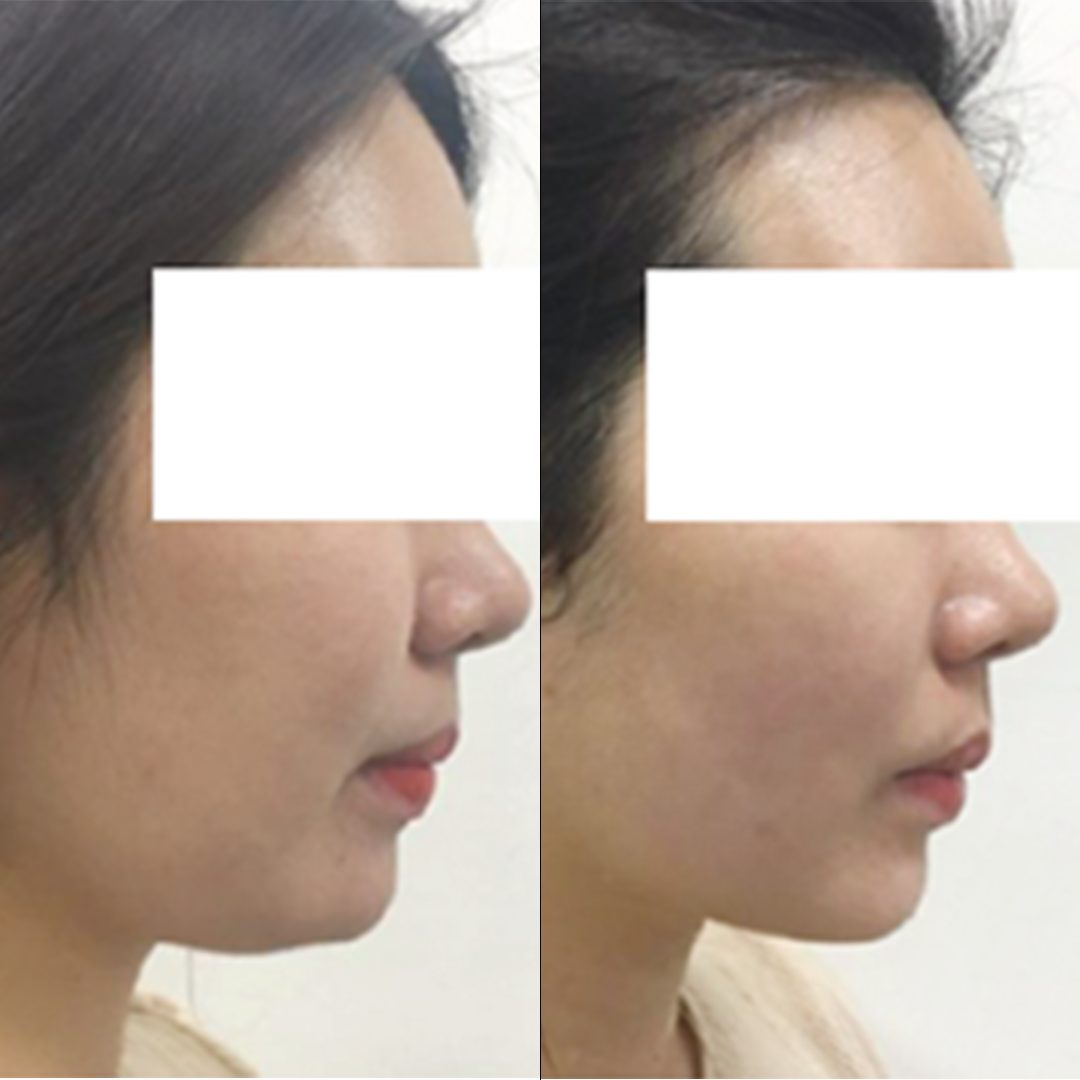 UTIMS A3 before and after result