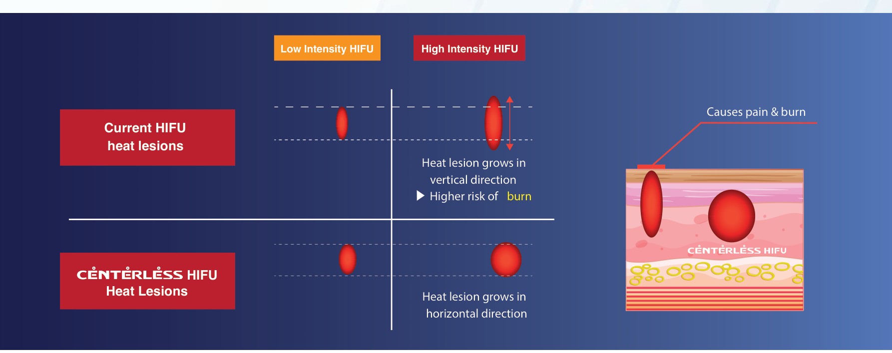 Current HIFU vertical heat lesion versus UTIMS centerless horizontal heat lesion